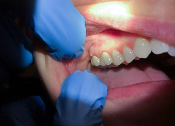 Best Knocked-Out Tooth (Avulsed Tooth) Treatment in Wartburg, TN